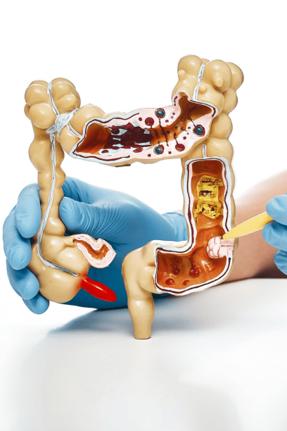 Colon Irritable